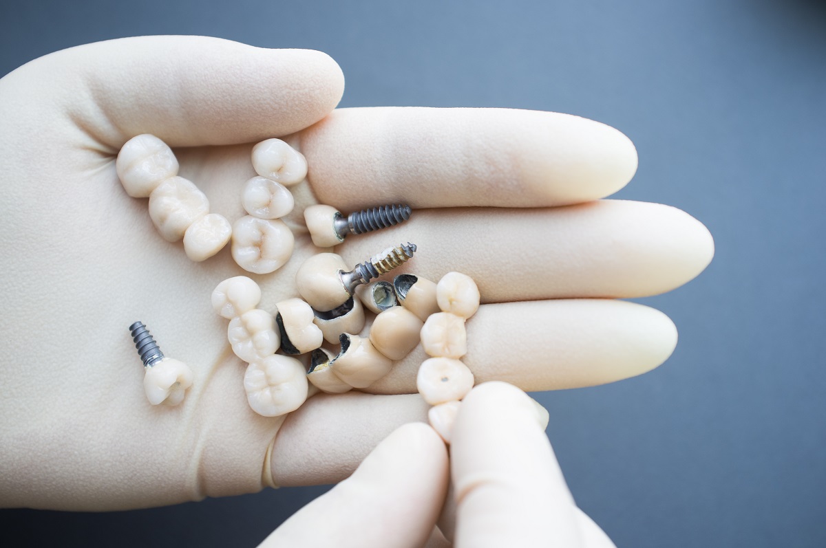 Dental implants Melbourne for tooth loss as a result of poor lifestyle choices